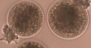 Pioneering new reproductive pathways with ICSI in Brazil