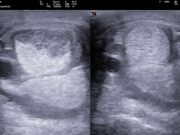 Equine tendinopathies: The new generation of treatments